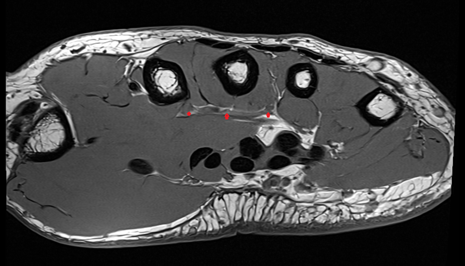 Deep palmar arch axial cross sectional anatomy 3T MRI AI enhanced radiology image-img-00000-00000_00002