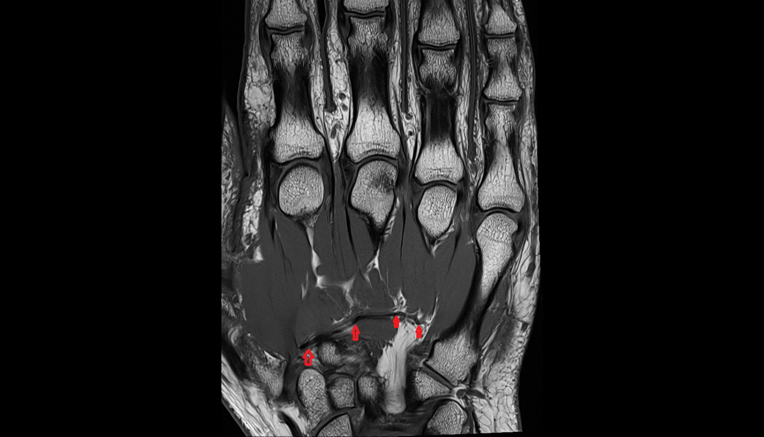 Deep palmar arch coronal cross sectional anatomy 3T MRI AI enhanced radiology image-img-00000-00000