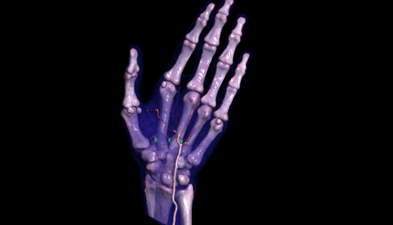 Deep palmar arch of hand 3D VRT  CT image -img-00000-00000