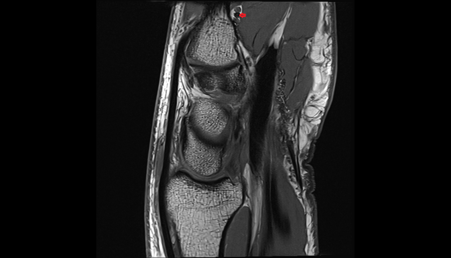Deep palmar arch sag cross sectional anatomy 3T MRI AI enhanced radiology image-img-00000-00000