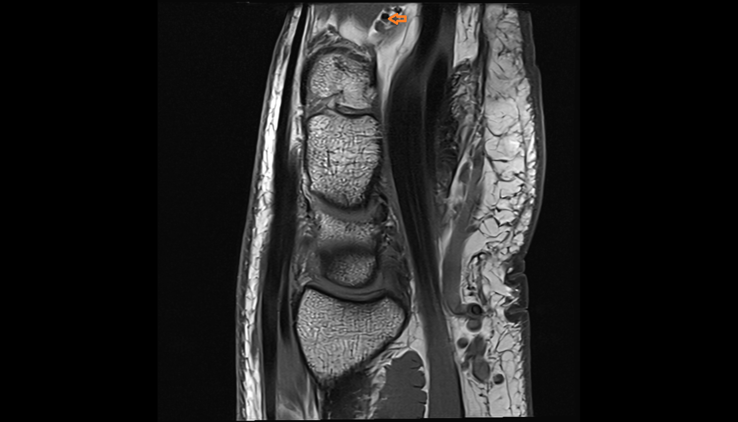 Deep palmar arch sag cross sectional anatomy 3T MRI AI enhanced radiology image-img-00000-00000_00001