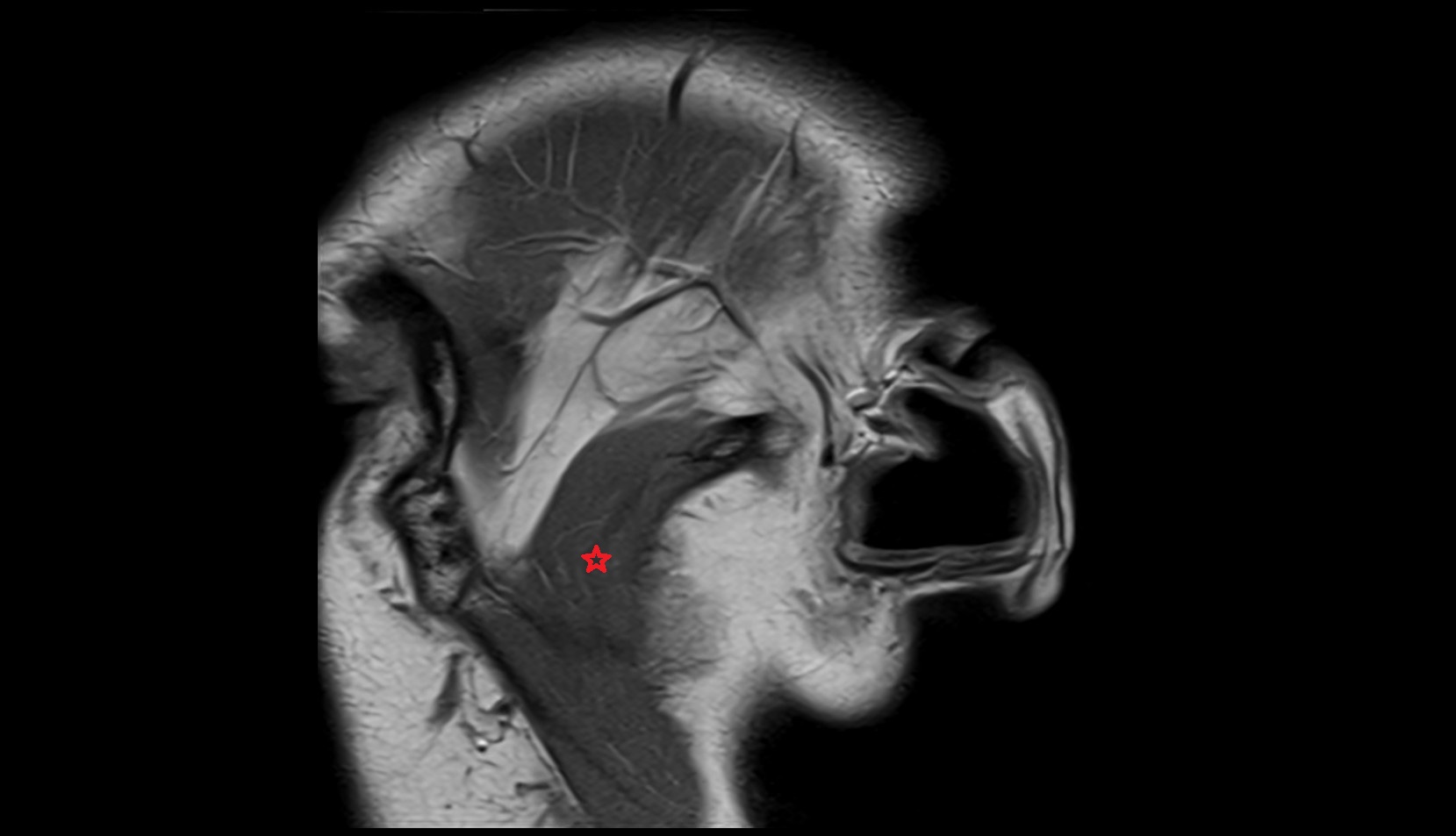 Deep part of masseter  muscle