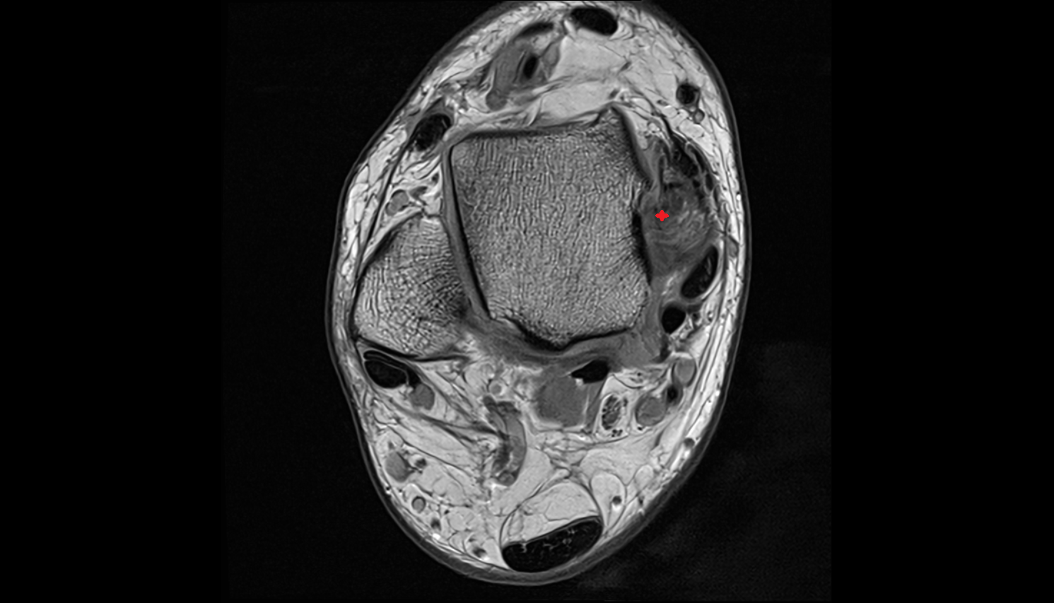 Deep posterior tibiotalar ligament (Deep deltoid) axial cross sectional anatomy 3T MRI AI enhanced radiology image-img-00000-00000