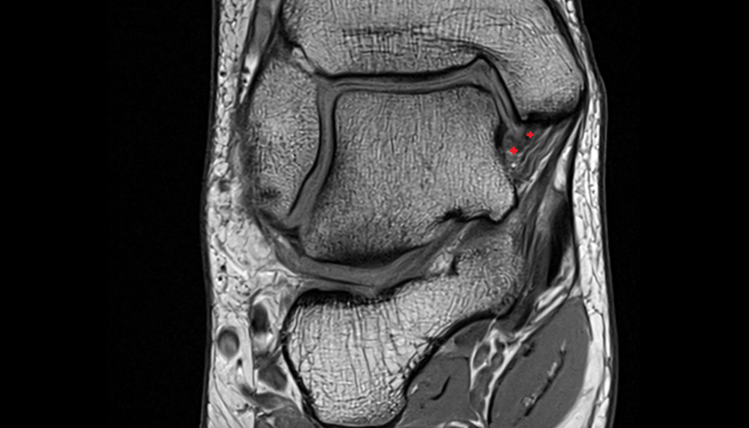 Deep posterior tibiotalar ligament (Deep deltoid) coronal cross sectional anatomy 3T MRI AI enhanced radiology image-img-00000-00000