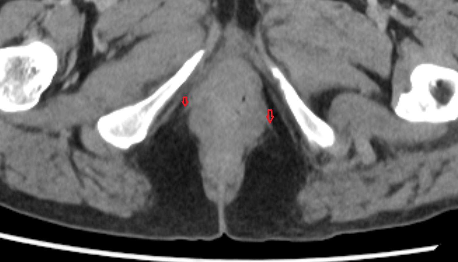 Deep  transverse perineal muscle   CT  axial  anatomy  image-img-00000-00000