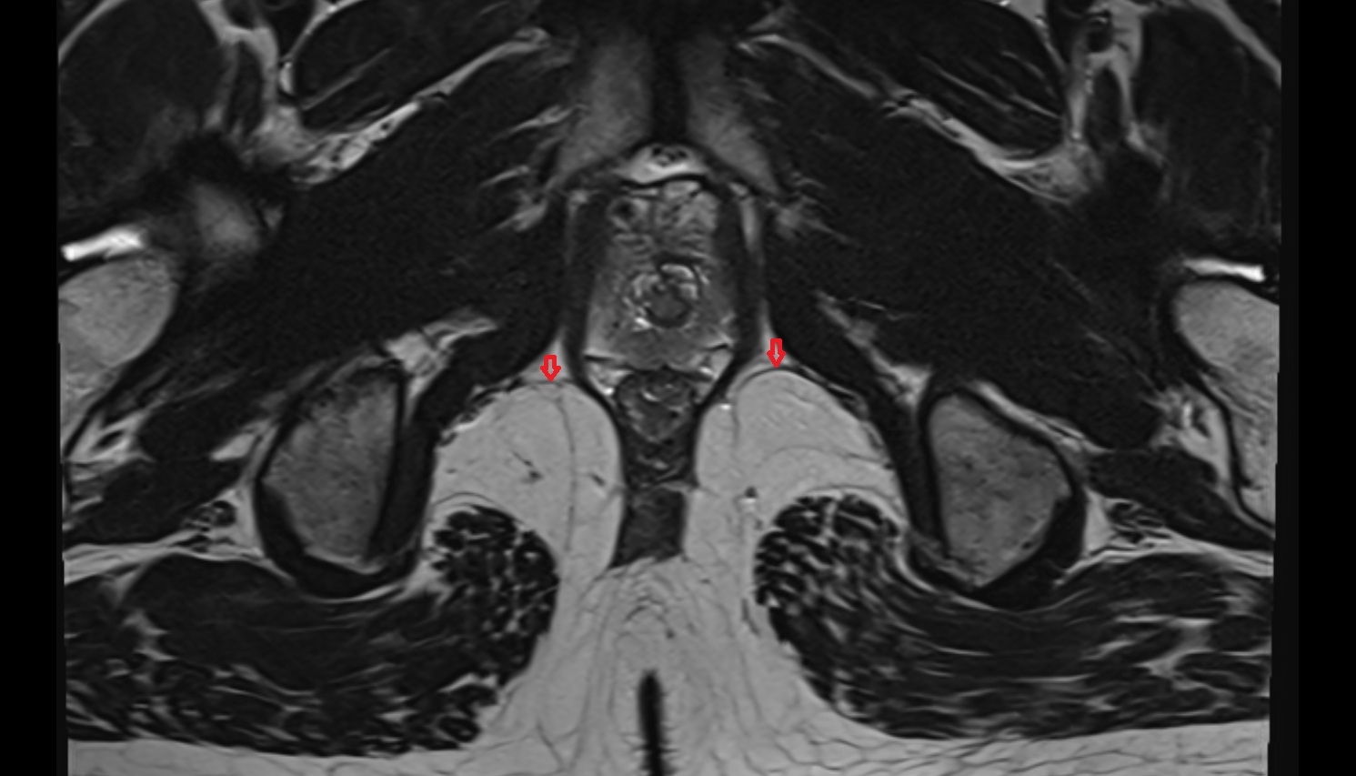 Deep  transverse perineal muscle   MRI  axial  anatomy  image-img-00000-00000