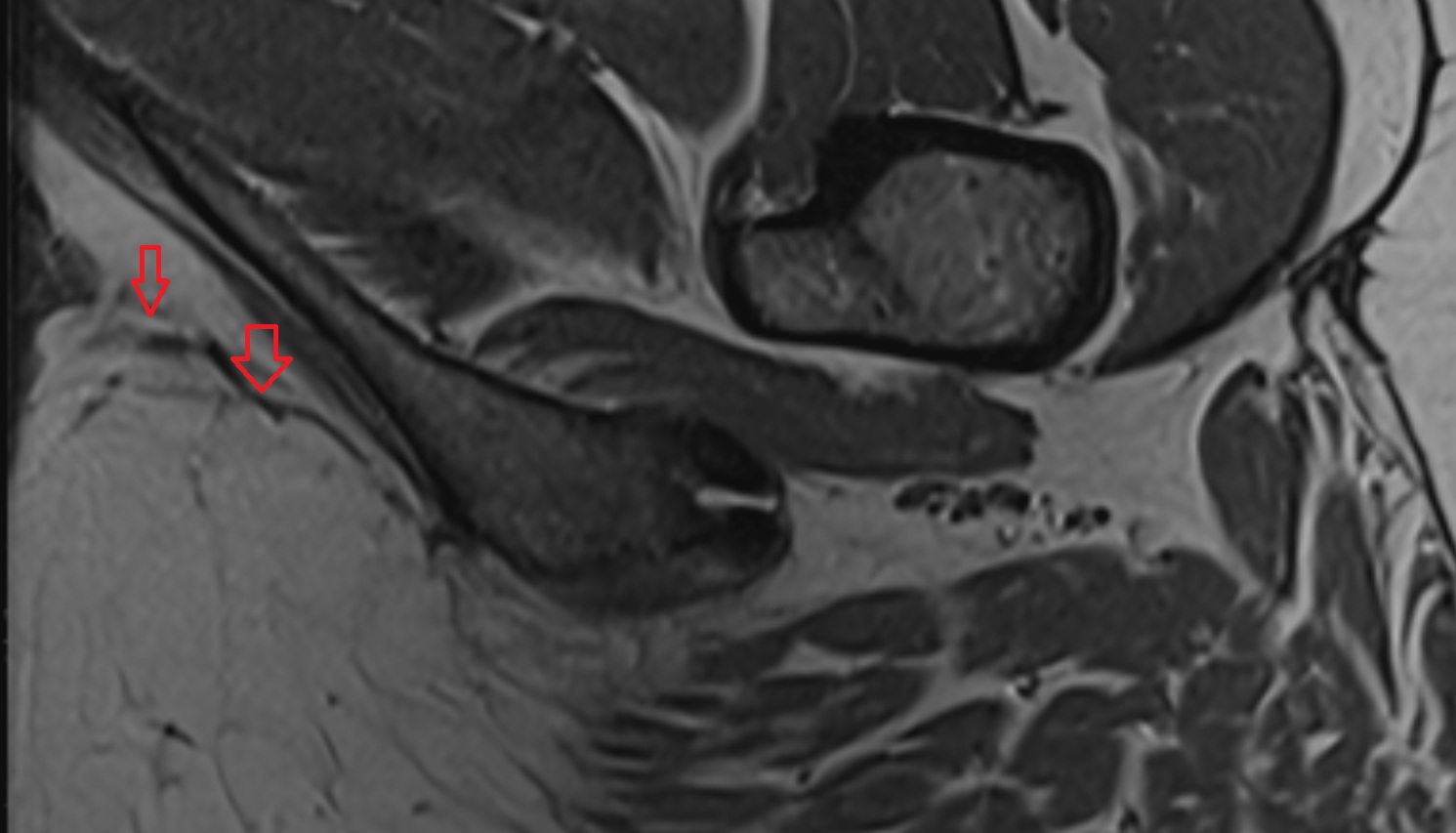 Deep  transverse perineal muscle   MRI  axial  anatomy  image-img-00000-00000_00001