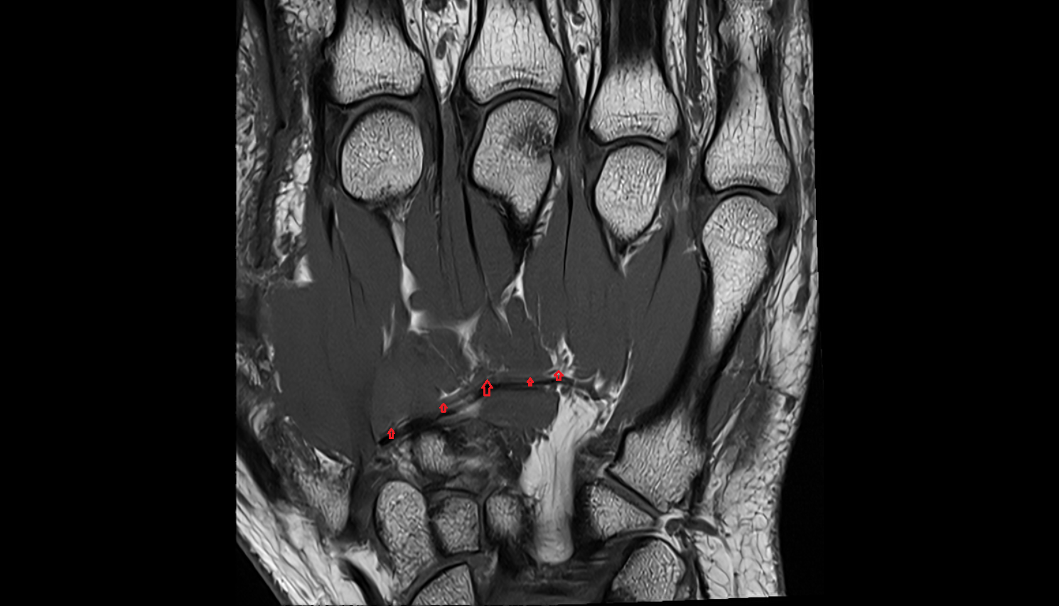 Deep venous palmar arch  coronal cross sectional anatomy 3T MRI AI enhanced radiology image-img-00000-00000
