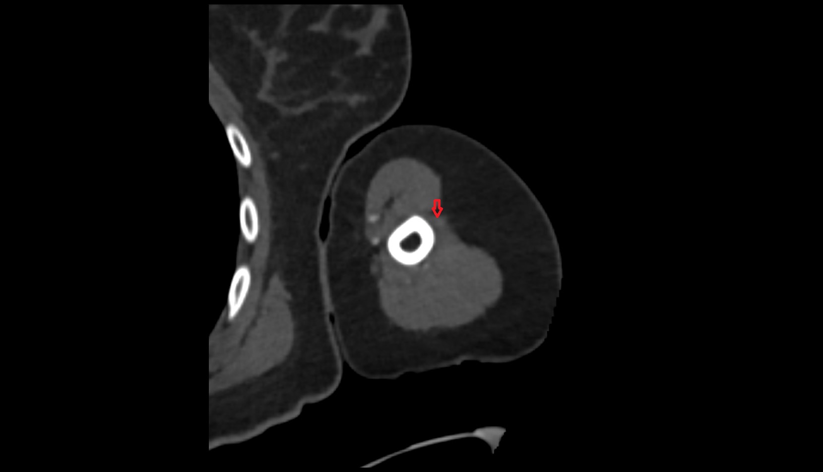 Deltoid Tendon (Distal) CT AXIAL IMGE