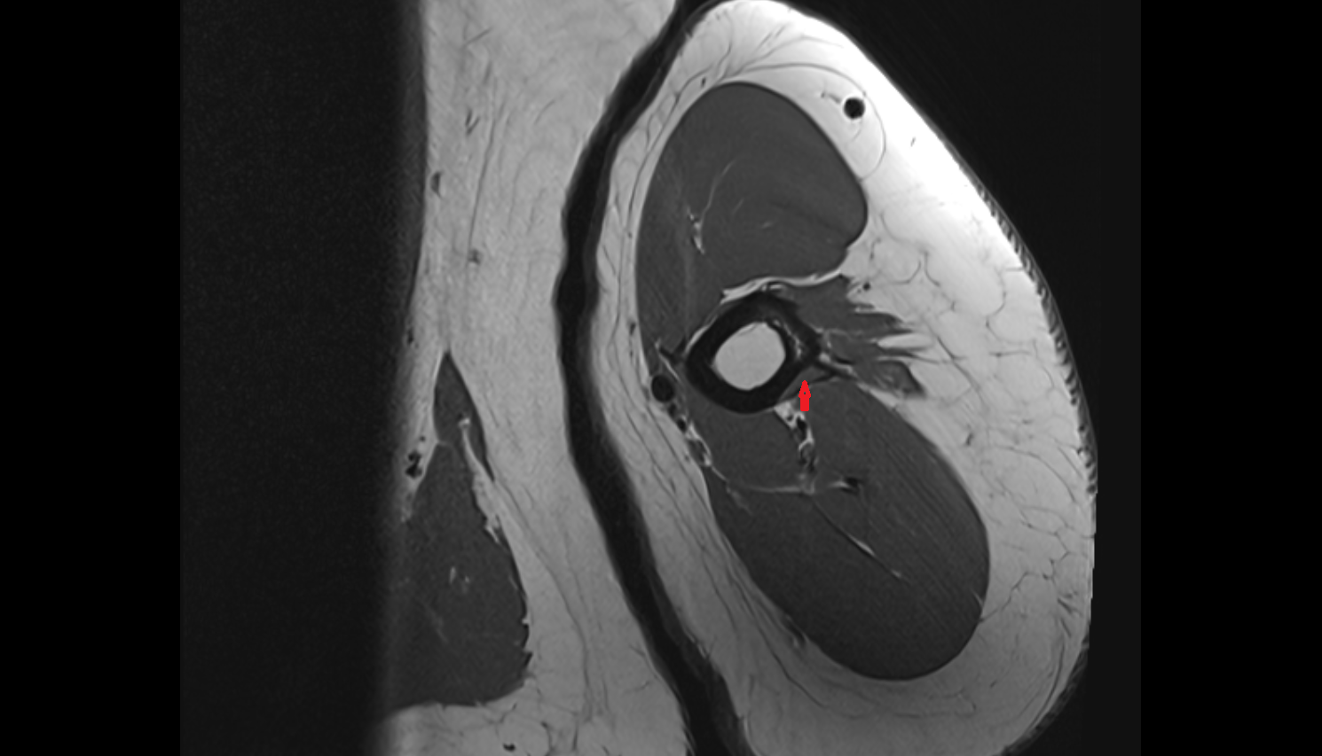 Deltoid Tendon (Distal) axial cross sectional anatomy 3T MRI AI enhanced radiology image-img-00000-00000
