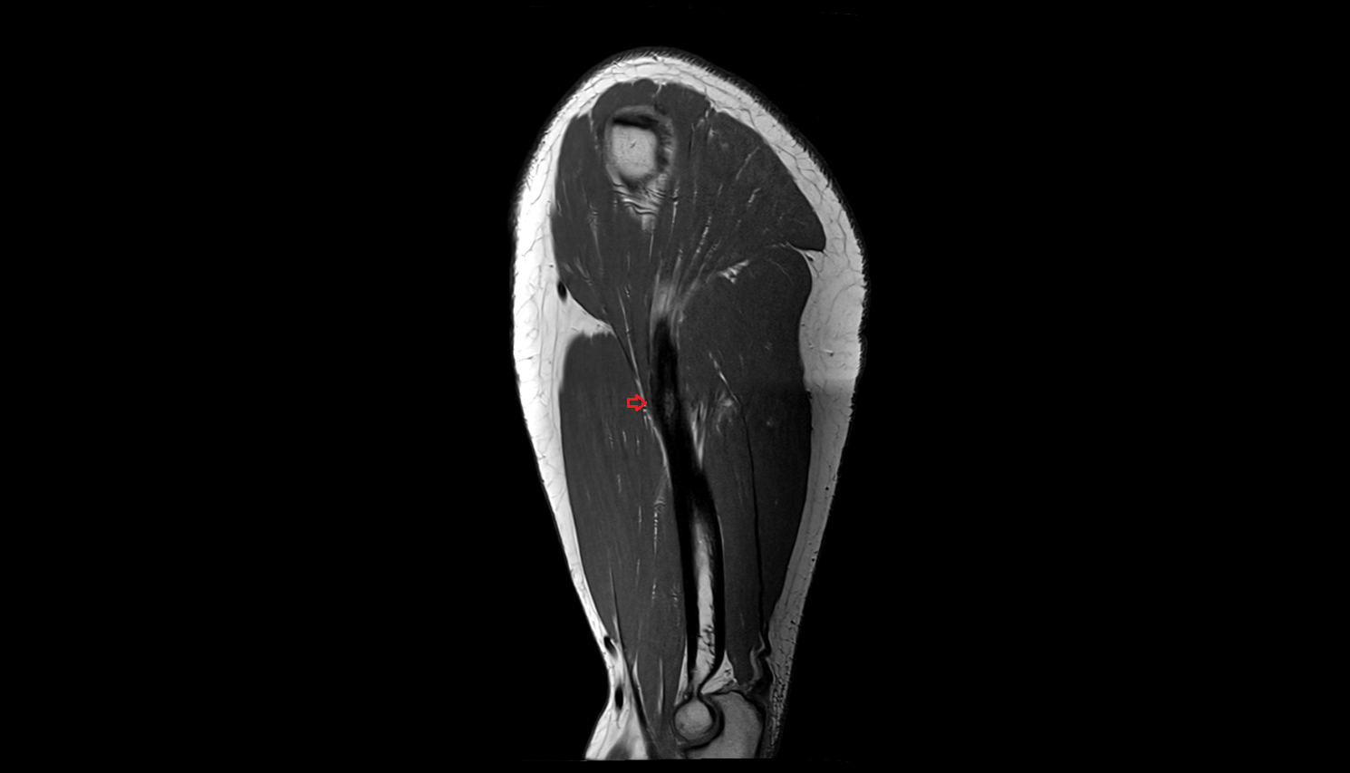 Deltoid Tendon (Distal)  sag cross sectional anatomy 3T MRI AI enhanced radiology image-img-00000-00000