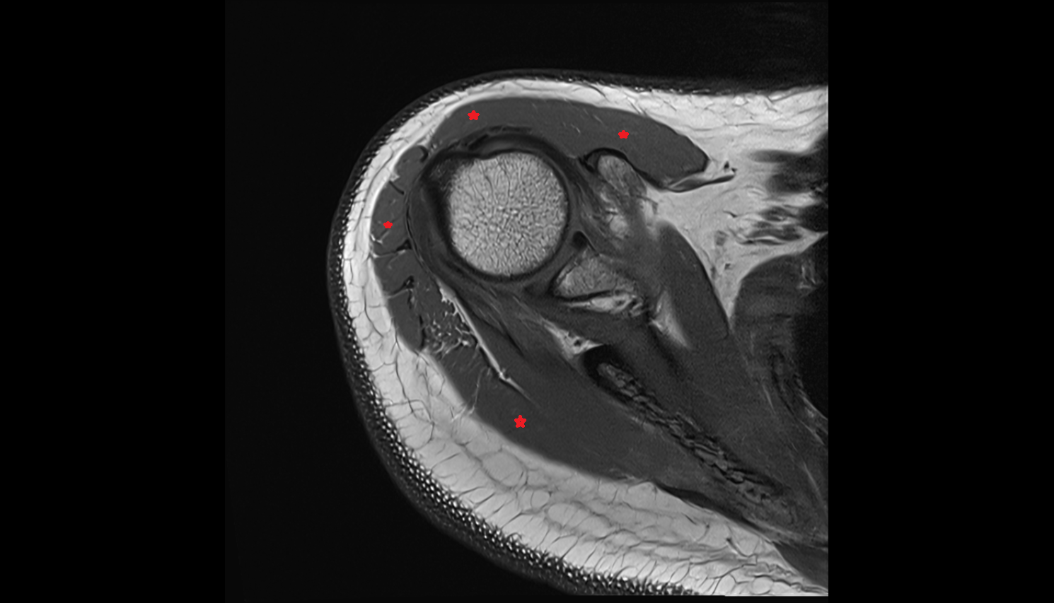 Deltoid muscle  axial cross sectional anatomy 3T MRI AI enhanced radiology image-img-00000-00000