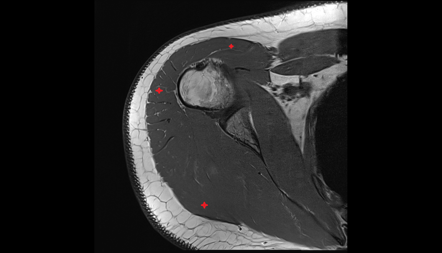 Deltoid muscle  axial cross sectional anatomy 3T MRI AI enhanced radiology image-img-00000-00000_00001
