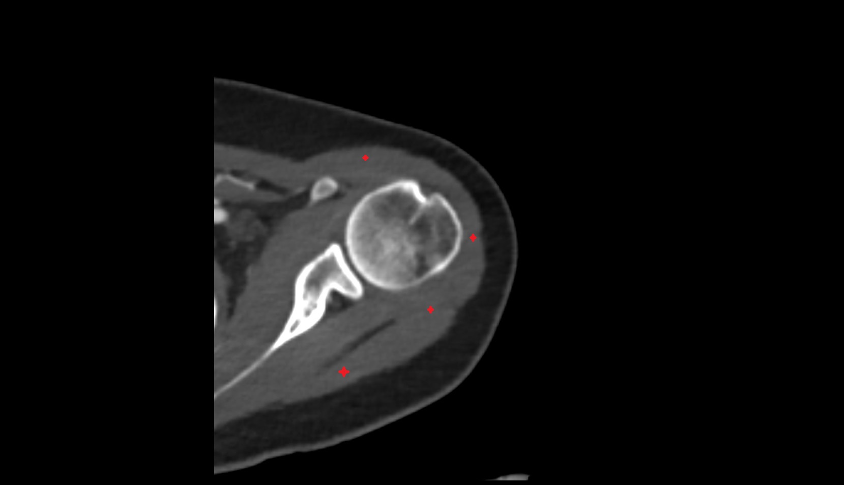 Deltoid muscle ct axial image