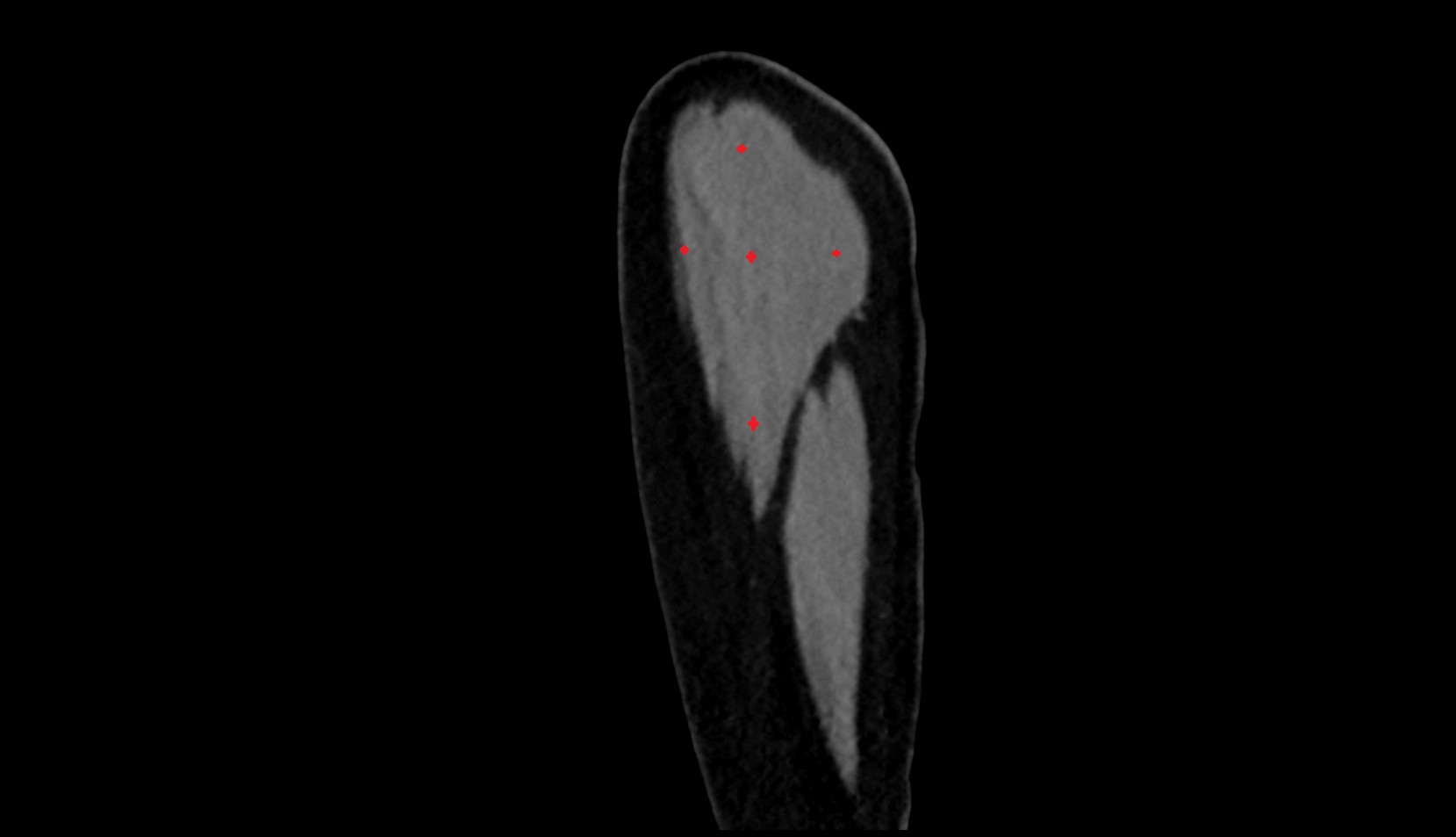 Deltoid muscle ct sag image