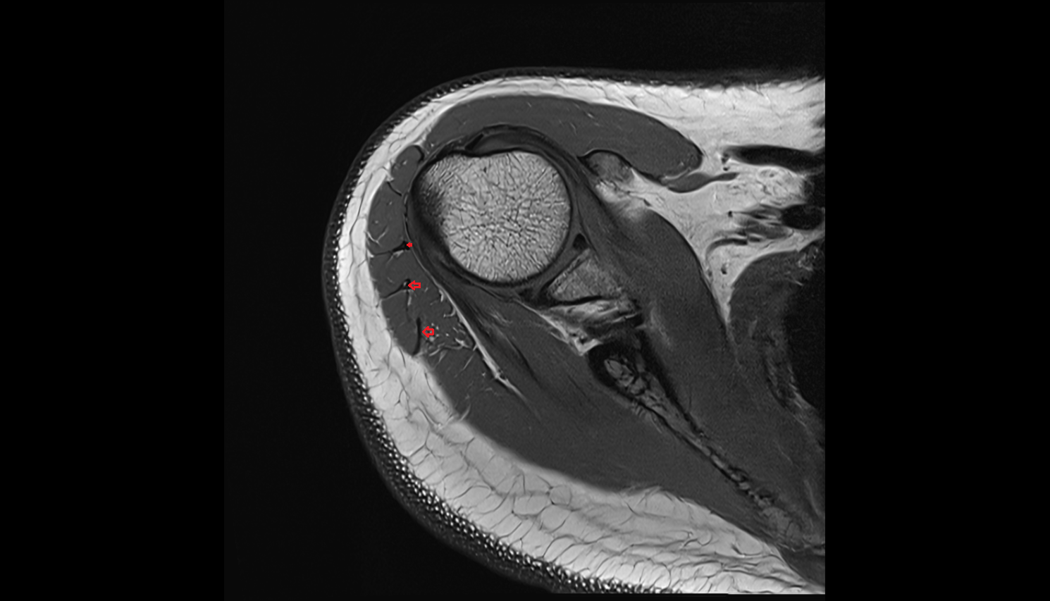 Deltoid tendon axial cross sectional anatomy 3T MRI AI enhanced radiology image-img-00000-00000