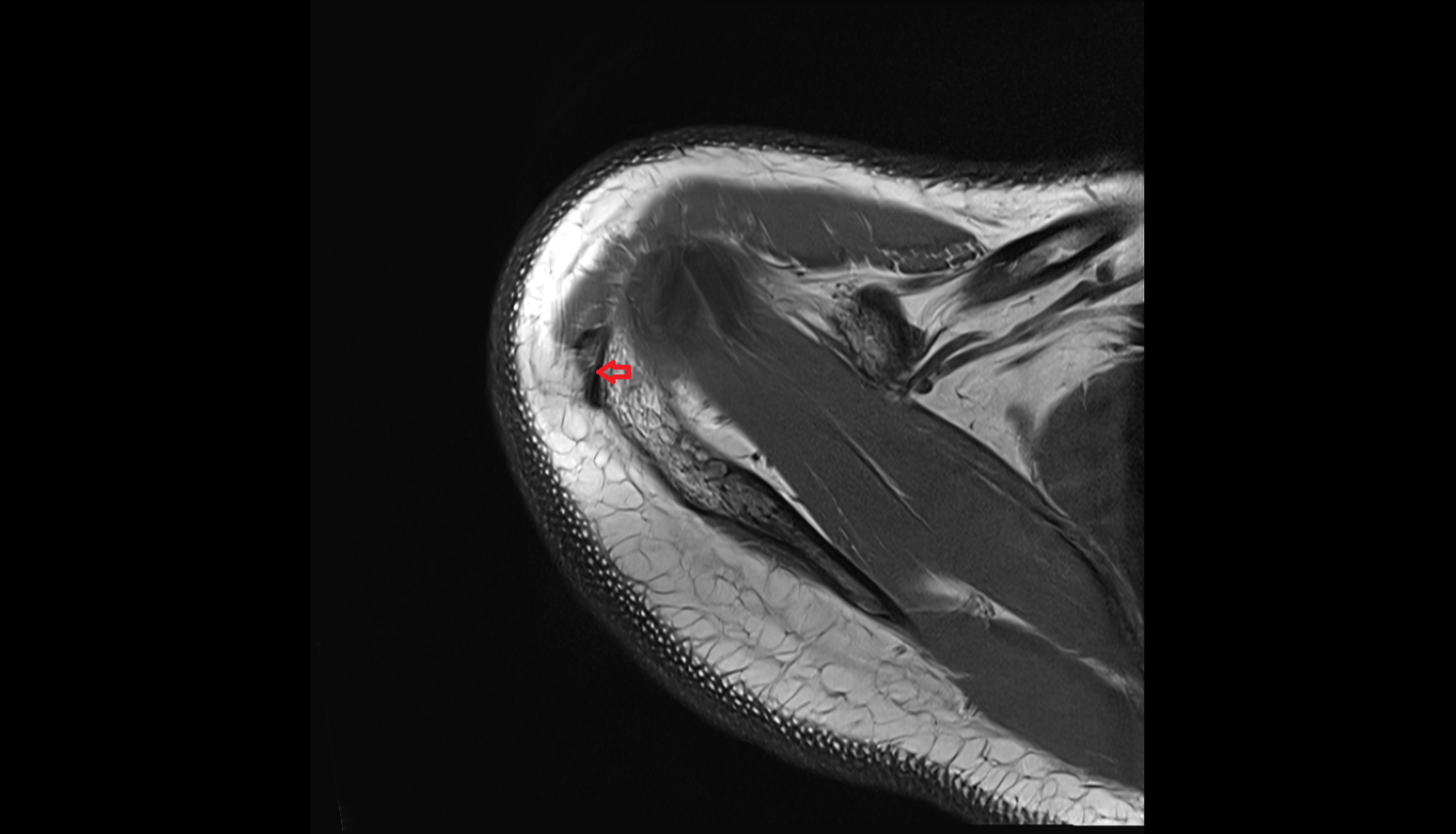 Deltoid tendon axial cross sectional anatomy 3T MRI AI enhanced radiology image-img-00000-00000_00001