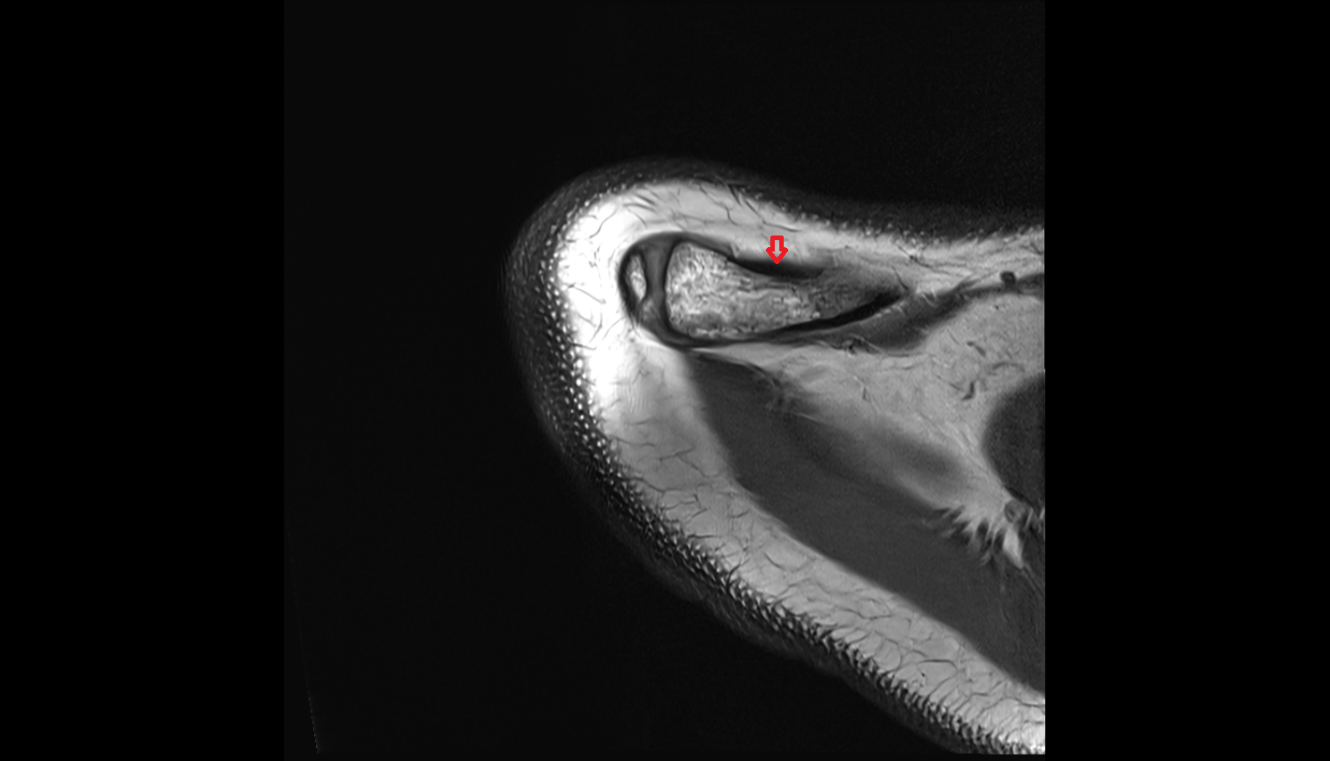 Deltoid tendon axial cross sectional anatomy 3T MRI AI enhanced radiology image-img-00000-00000_00002