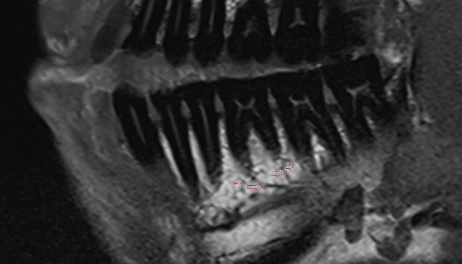 Dental branches of inferior alveolar artery, vein, & nerve  mri sagittal  image -img-00000-00000