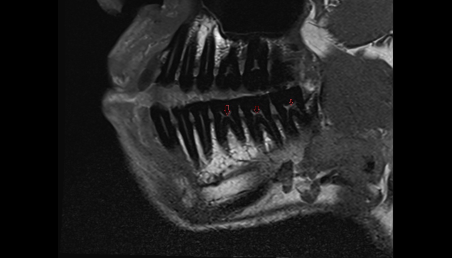 Dental pulp of lower molar tooth  mri sagittal  image -img-00000-00000