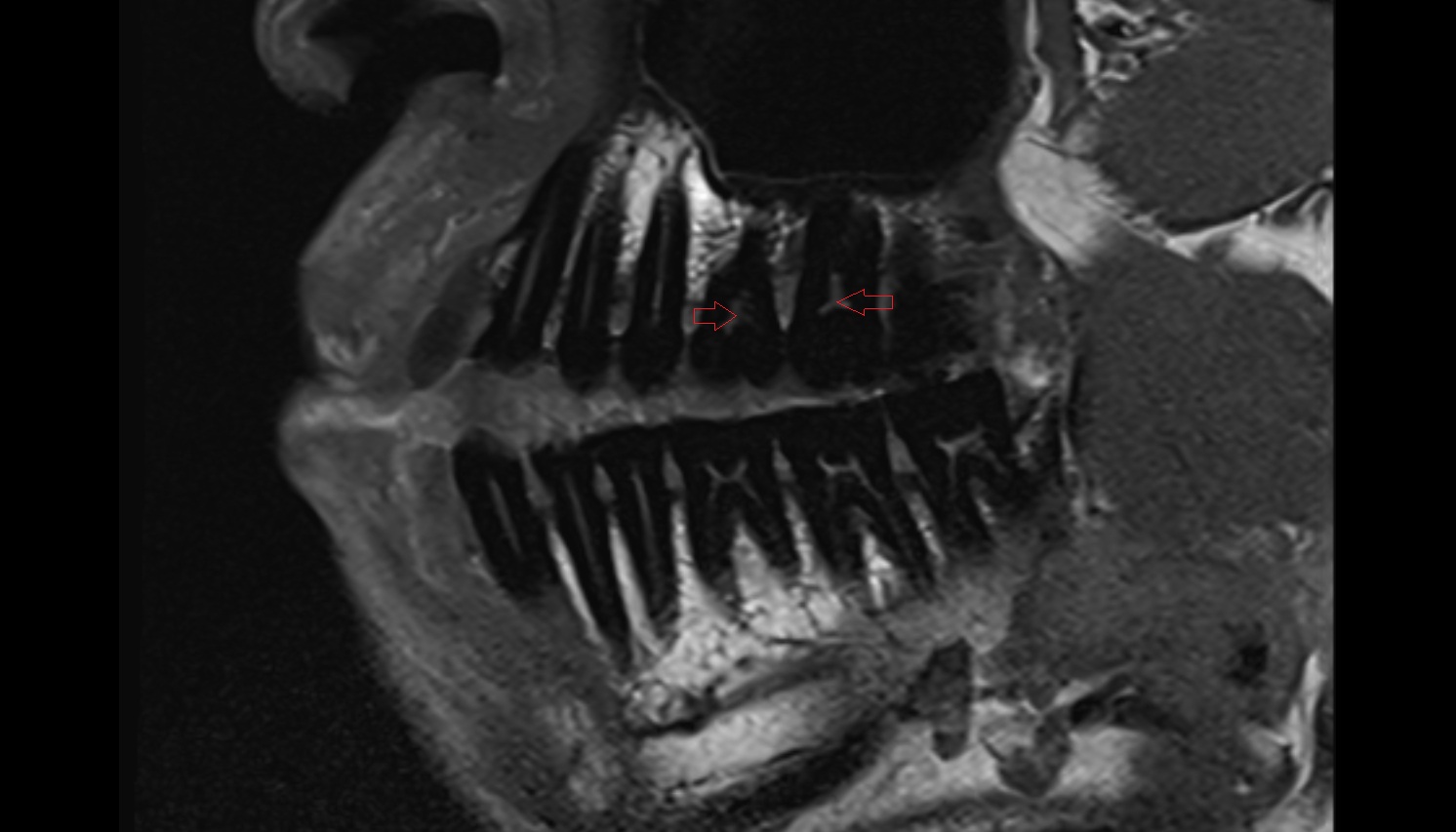 Dental pulp of  upper molar tooth  mri sagittal  image -img-00000-00000