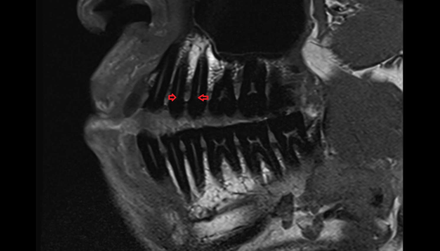 Dental pulp of  upper premolar tooth  mri sagittal  image -img-00000-00000