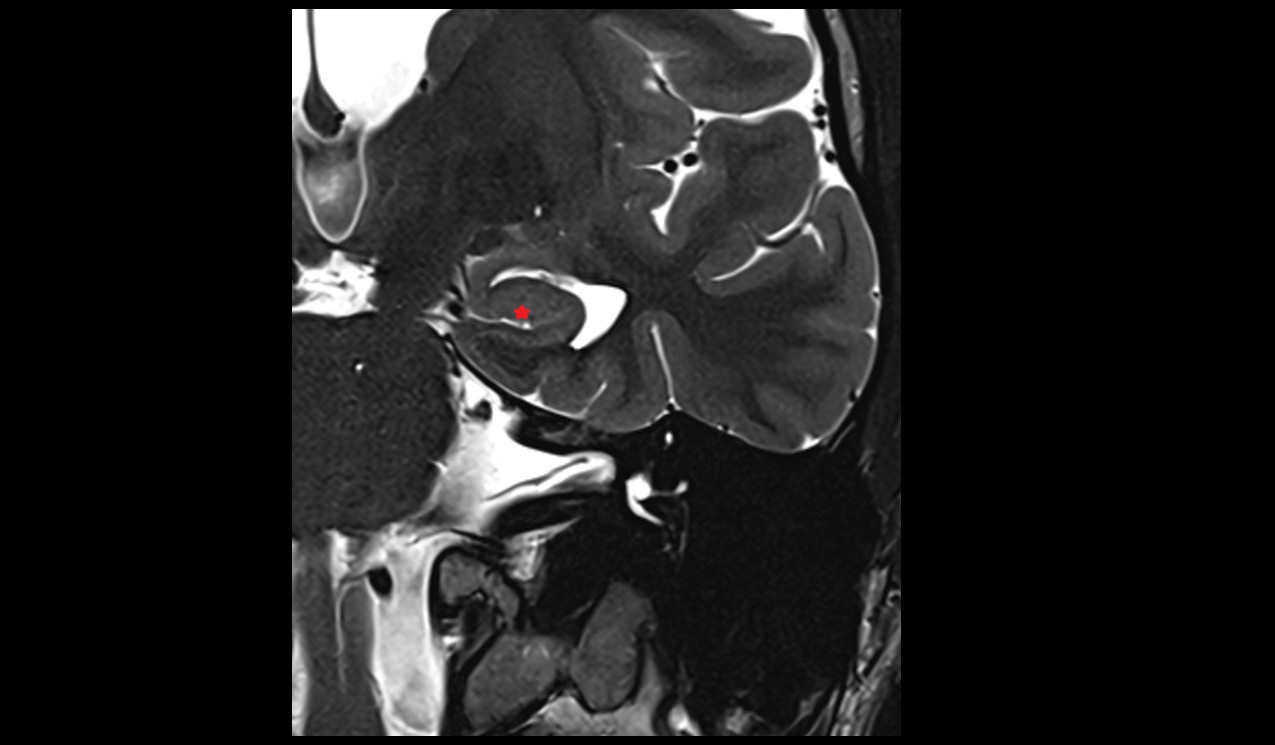 Dentate gyrus mri 3t coronal image