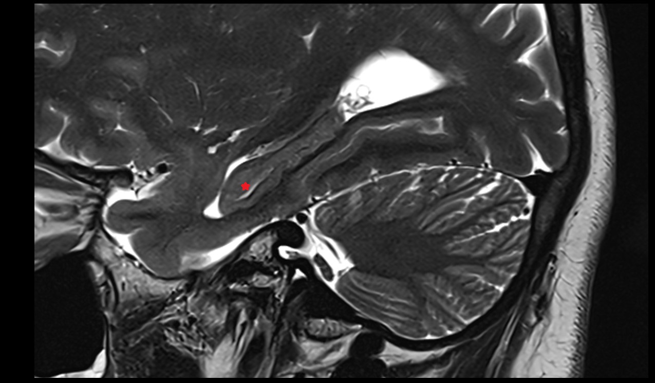 Dentate gyrus mri 3t coronal sagittal