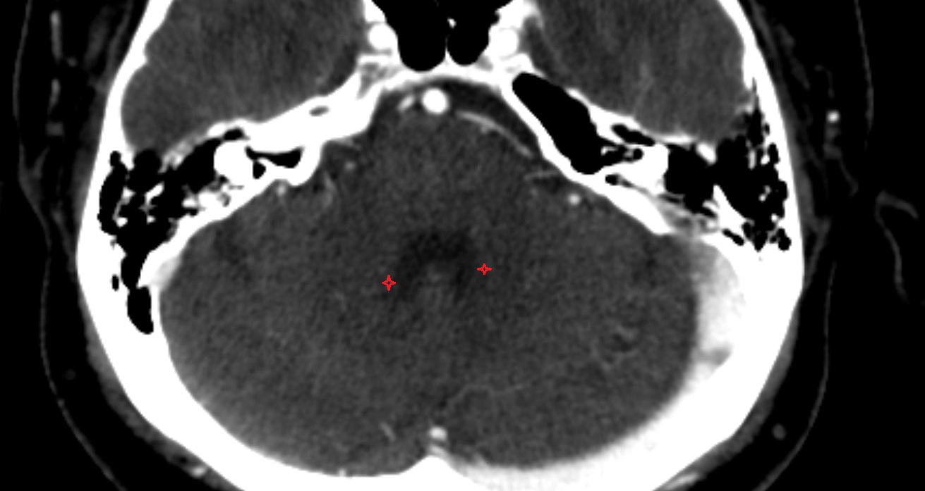 Dentate nucleus CT axial  anatomy image -img-00001-00001