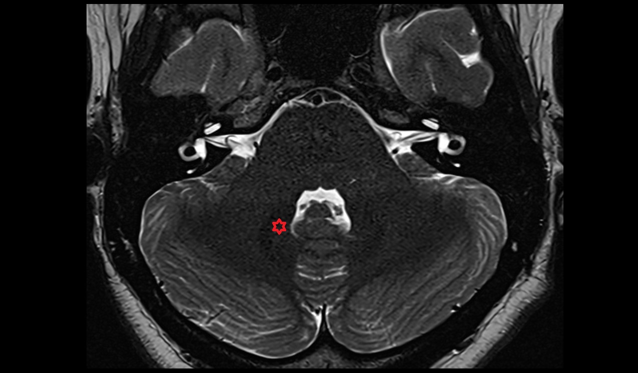 Dentate nucleus; Nucleus lateralis cerebelli MRI 3T axial image