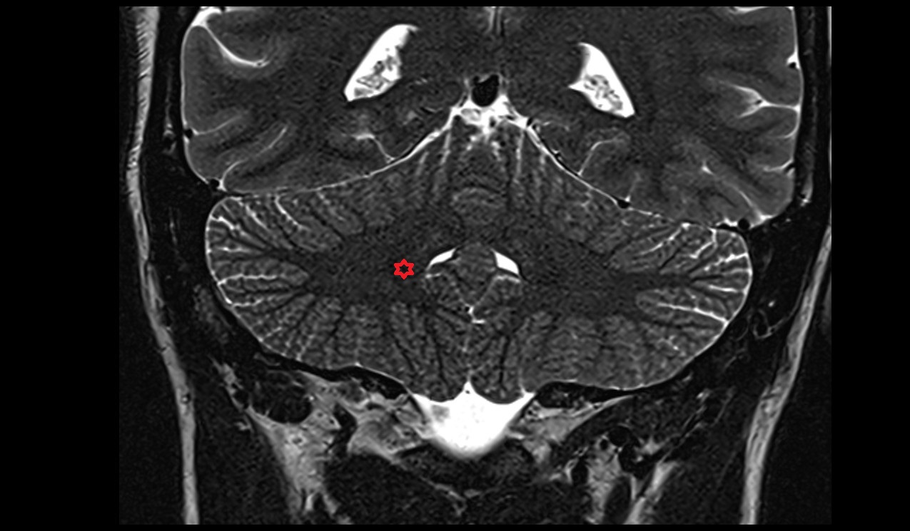 Dentate nucleus; Nucleus lateralis cerebelli MRI 3T coronal  image