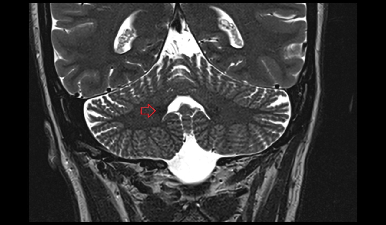 Dentate nucleus; Nucleus lateralis cerebelli coronal MRI 3T image