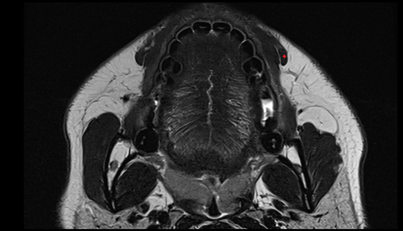 Depressor anguli oris muscle mri axial image