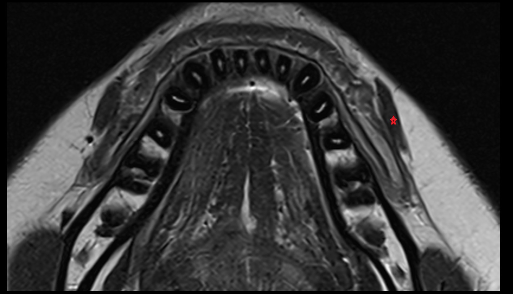 Depressor anguli oris muscle mri axial image1