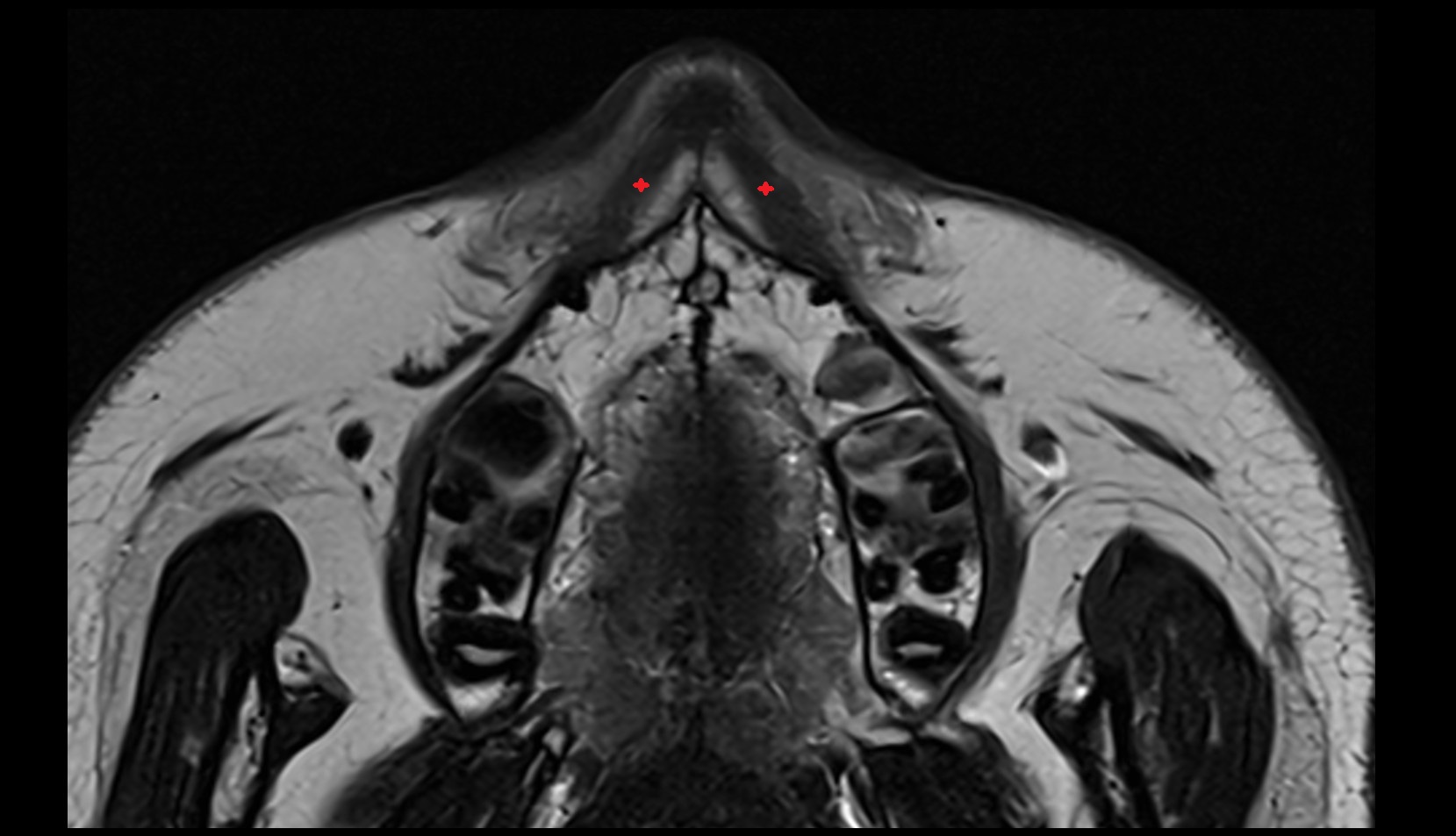 Depressor septi nasi muscle mri axial image