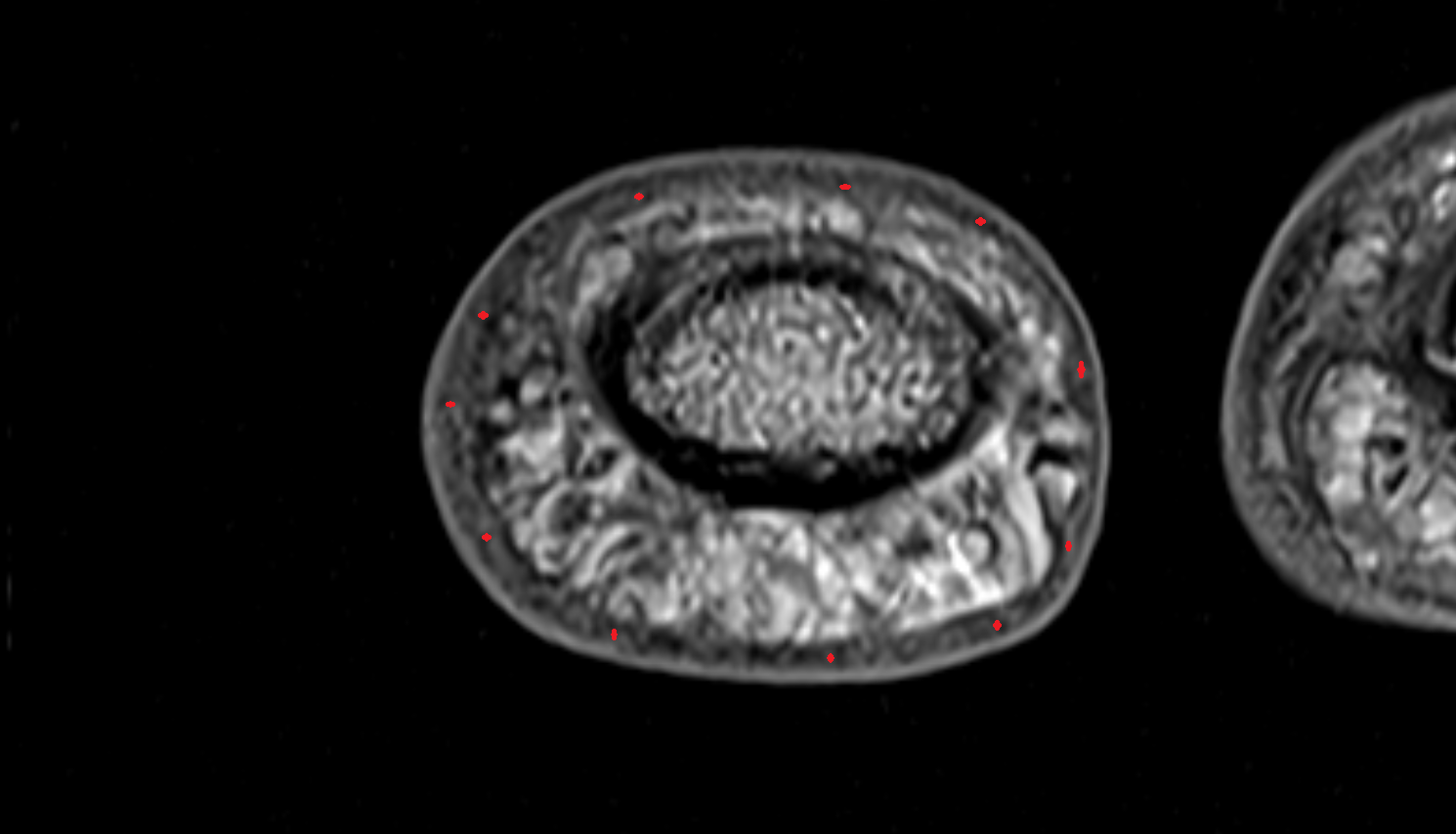 Dermis of skin hand  MRI axial  image-img-00000-00000