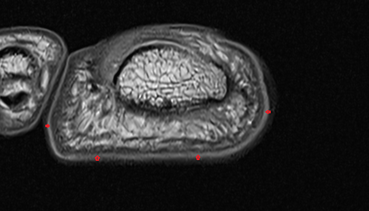 Dermis of skin of skin of foot axial cross sectional anatomy 3T MRI AI enhanced radiology image-img-00000-00000