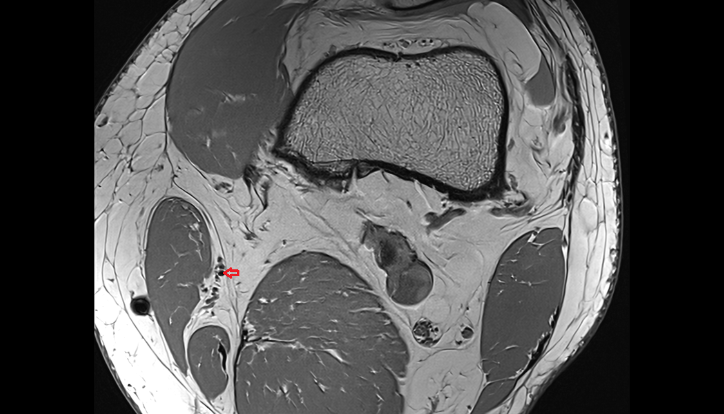 Descending Genicular Artery (Saphenous Branch)  axial  cross sectional anatomy 3T MRI AI enhanced  radiology  anatomy image-img-00000-00000