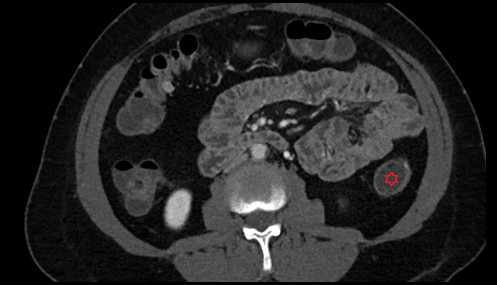 Descending colon CT axial image