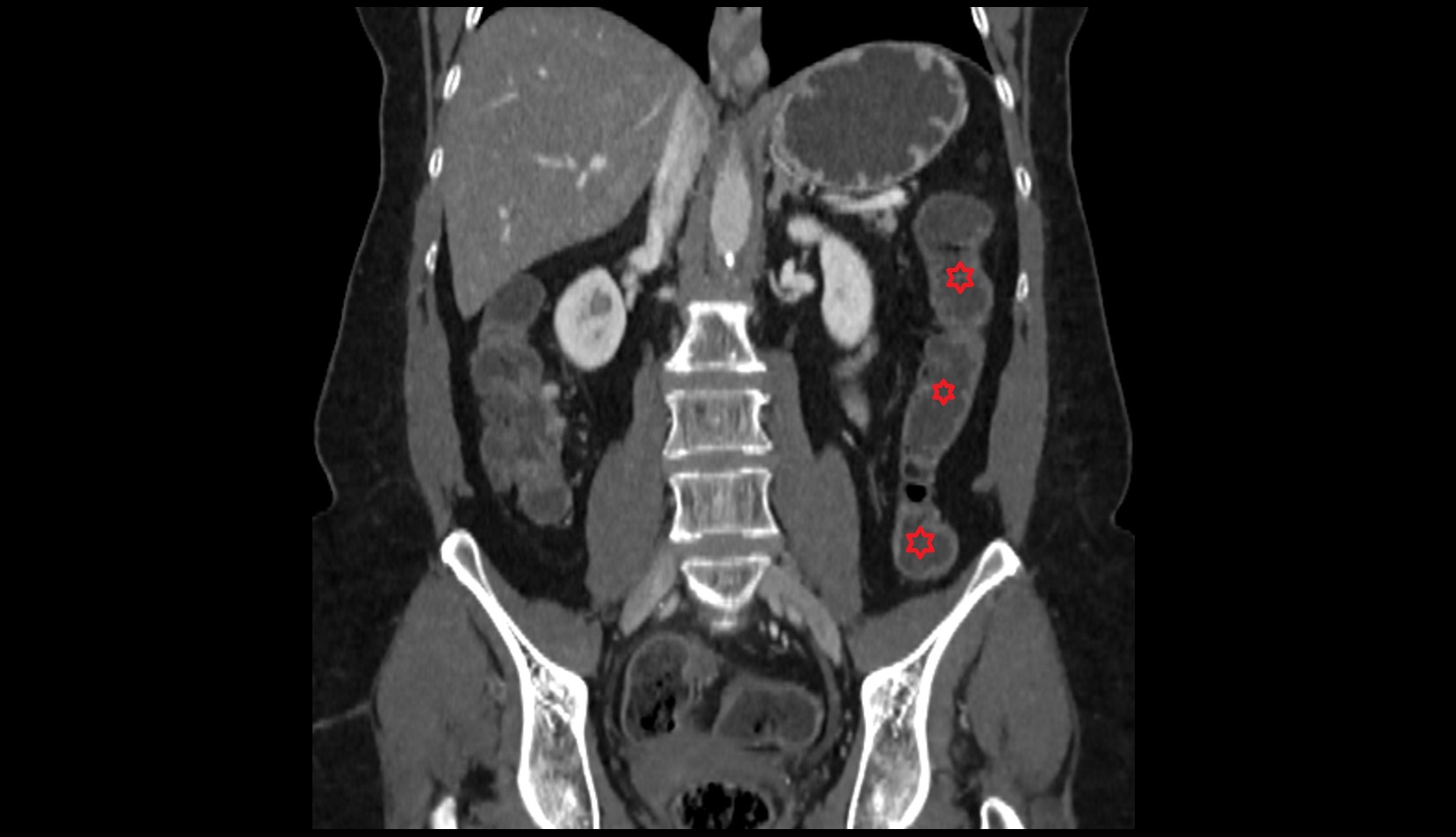 Descending colon CT coronal  image