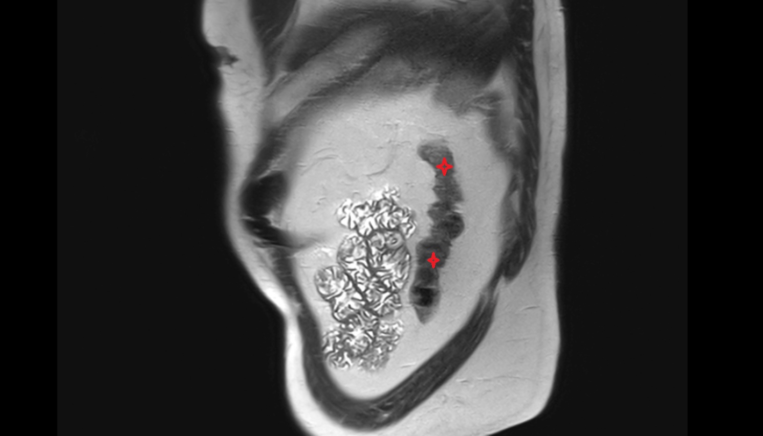 Descending colon   MRI sagittal image anatomy  image -img-00000-00000