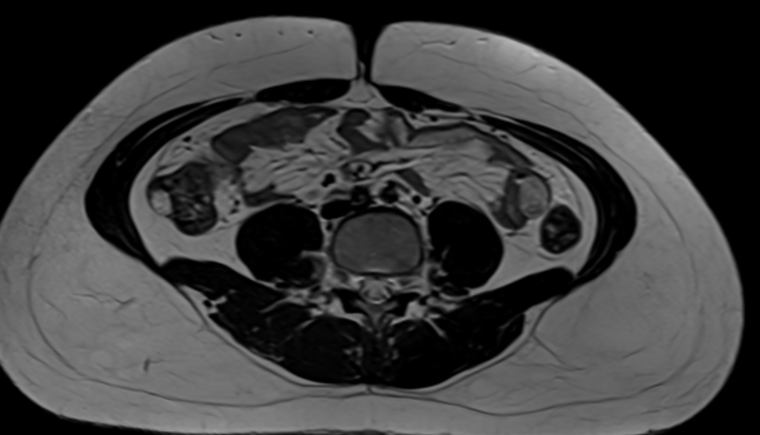 Descending colon  anatomy  MRI axial  image -img-00000-00000