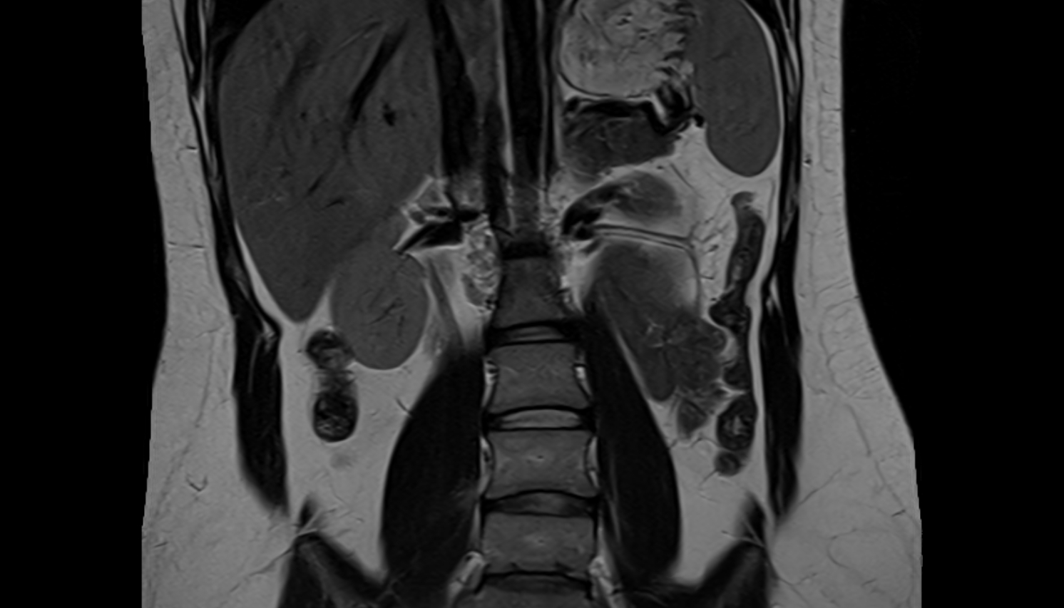 Descending colon  anatomy  MRI coronal  image -img-00000-00000