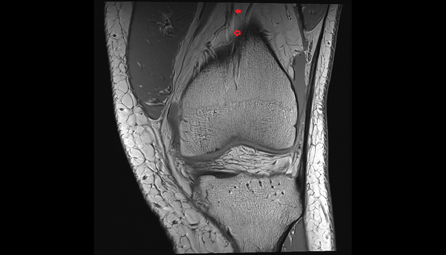 Descending genicular artery (articular branches)  CORONAL  cross sectional anatomy 3T MRI AI enhanced  radiology  anatomy image-img-00000-00000