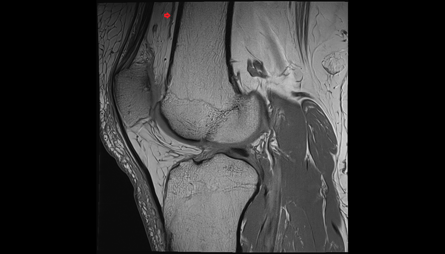 Descending genicular artery (articular branches)  CORONAL  cross sectional anatomy 3T MRI AI enhanced  radiology  anatomy image-img-00000-00000_00001