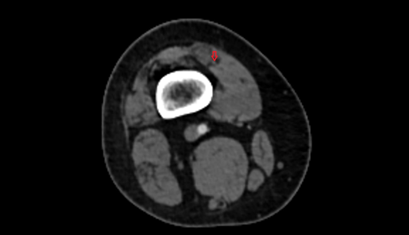 Descending genicular artery (articular branches) CT AXIAL