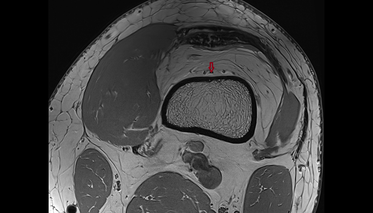Descending genicular artery  axial  cross sectional anatomy 3T MRI AI enhanced  radiology  anatomy image-img-00000-00000