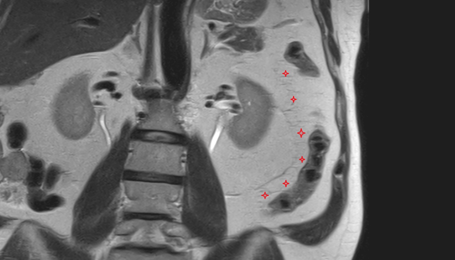 Descending mesocolon  MRI  coronal image anatomy  image -img-00000-00000