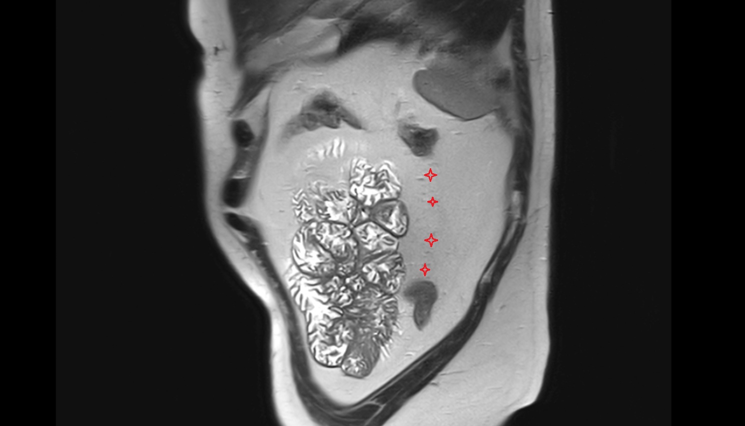 Descending mesocolon  MRI sagittal image anatomy  image -img-00000-00000