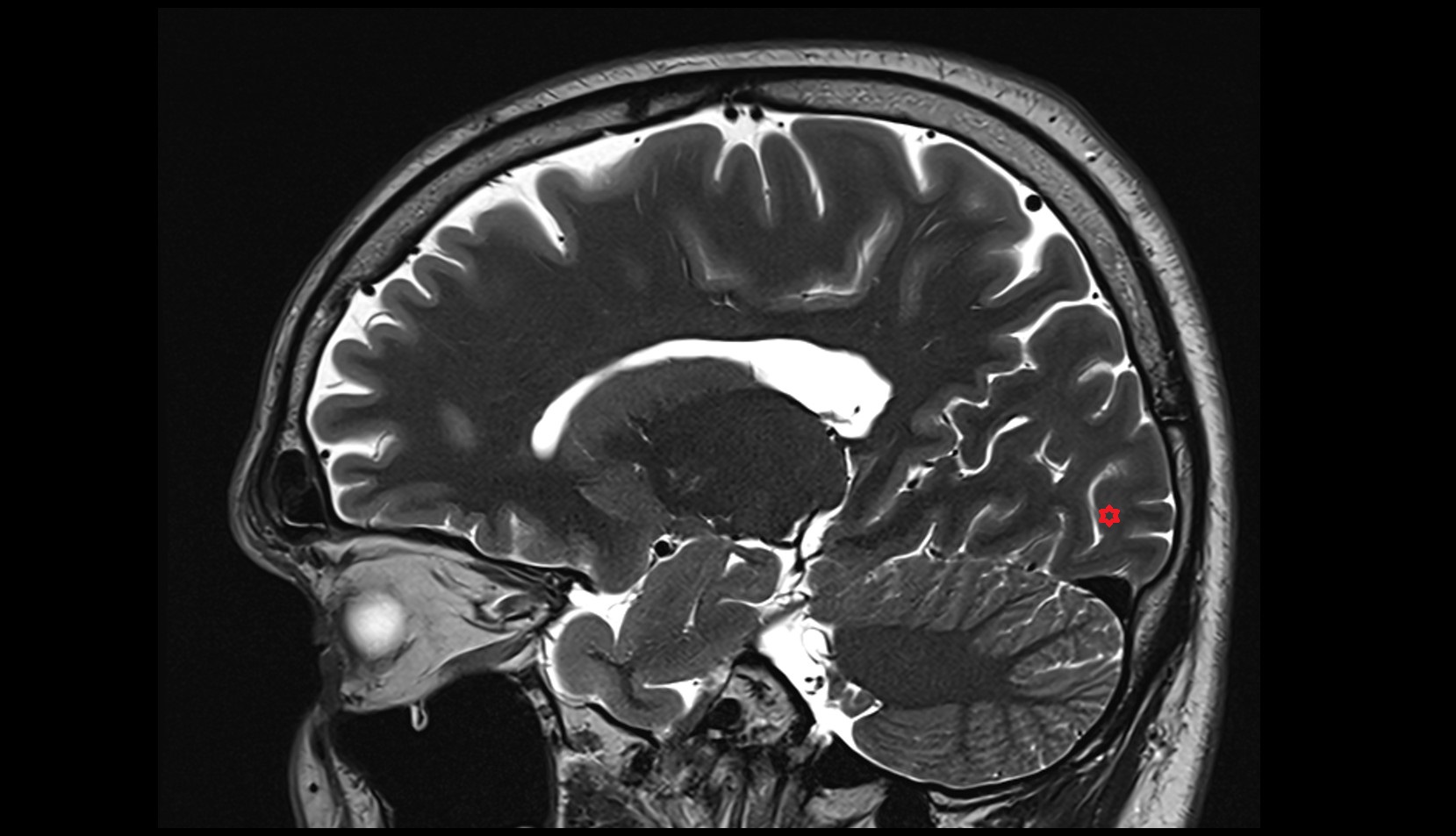 Descending occipital gyrus mri 3t sagittal image